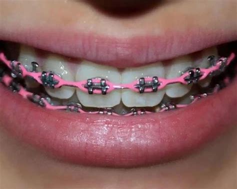 regular braces vs power chain.